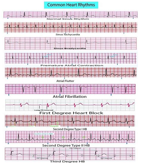 ecg result validity period philippines|ECG Signal Quality: A Practical Guide for ECG Readings.